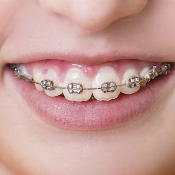 Orthodontic treatment